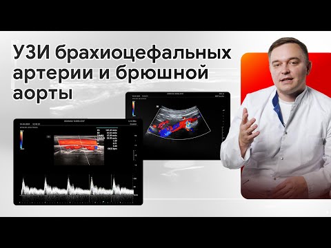 Видео: УЗИ брахиоцефальных артерии и брюшной аорты на Mindray Resona i9