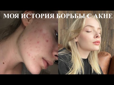 Видео: МОЯ БОРЬБА С АКНЕ I откат после Сотрета, шейминг и другое