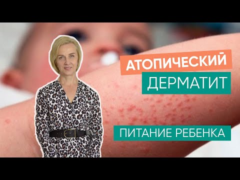 Видео: Атопический дерматит и питание ребенка