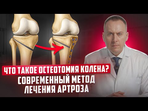 Видео: Что такое корригирующая остеотомия? Как можно избежать эндопротезирования колена?