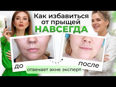 Видео: КАК ВЫЛЕЧИТЬ ПРЫЩИ | Нужны ли ретиноиды, шлифовка, пилинги? Отвечает врач дерматолог @drkonstanta