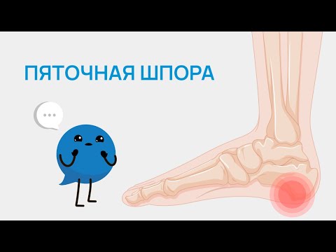 Видео: Пяточная шпора