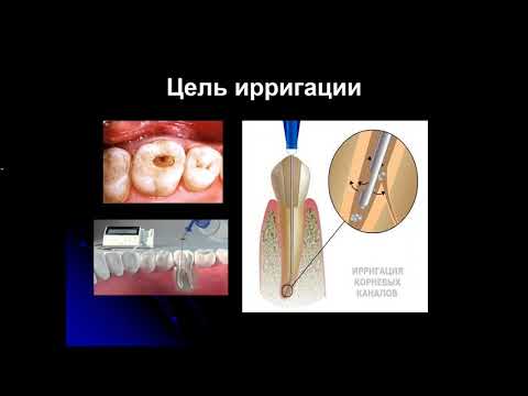 Видео: Эндодонтия 2.Ирригация системы корневого канала