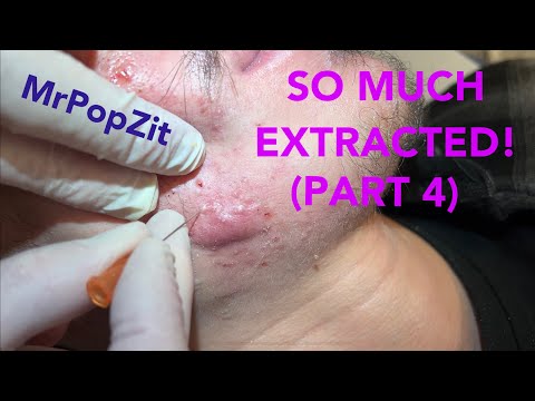 Видео: Столько всего вытащили! Сильная угревая сыпь до и после. Сеанс 2. Комедоны на несколько дней.