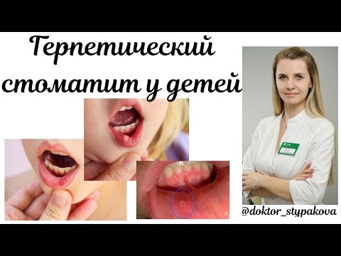 Видео: Герпетический стоматит у детей.Диагностика.Лечение.