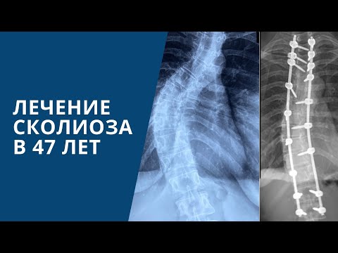 Видео: Лечение сколиоза в 47 лет