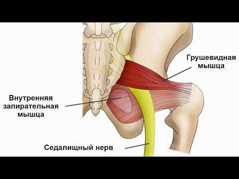 Видео: Синдром грушевидной мышцы. Малиновская