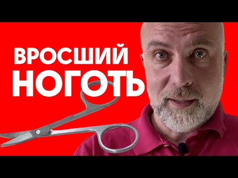 Видео: Вросший ноготь лечение в домашних условиях. Первая помощь