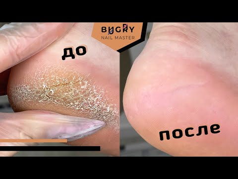 Видео: РАБОТА ДИСКОМ С ТРЕЩИНАМИ / ПРЕПАРАТНЫЙ ПЕДИКЮР / #ТатьянаБугрий