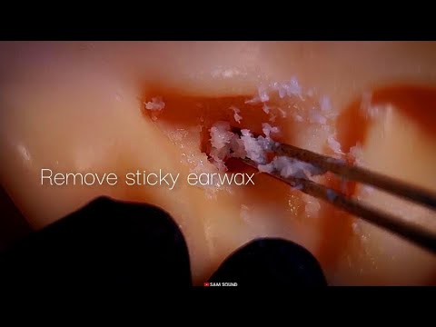 Видео: ASMR Новое средство для удаления ушной серы, которое вы ищете❤️Visual tingle★Ватные палочки и пинцет