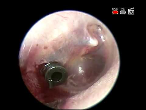 Видео: Шунтирование