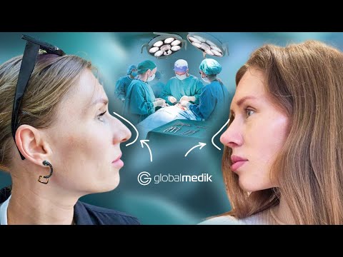 Видео: Ринопластика в Стамбулі: які результати через 2,5 місяця.