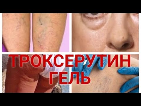 Видео: Троксерутин гель. Аптечная мазь от варикоза, отеков, мешков под глазами и целлюлита.