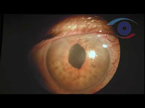 Видео: Факоэмульсификация осложненной катаракты при полном иридокорнеальном контакте