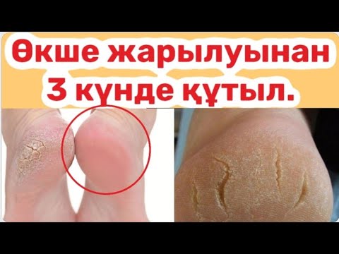 Видео: Өкше жарылуынан тез құтылу жолдары. Суперрецепт.