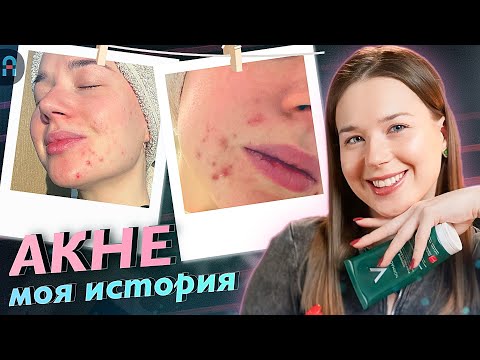 Видео: Как ИЗБАВИТЬСЯ от ПРЫЩЕЙ? / Моя история борьбы с АКНЕ