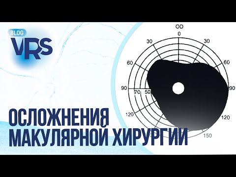 Видео: Осложнения макулярной хирургии