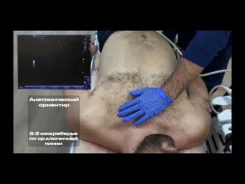 Видео: eFAST протокол в структуре неотложной помощи ЦЭМП