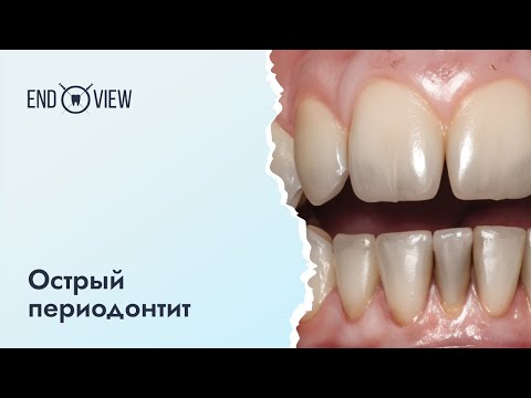 Видео: Острый периодонтит - причины, симптомы и лечение