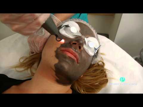 Видео: Процедура «Голливудский пилинг» с помощью Spectra Laser в клинике Premier Laser