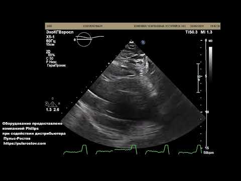 Видео: Электрокардиостимулятор. Нарушение кинеза миокарда