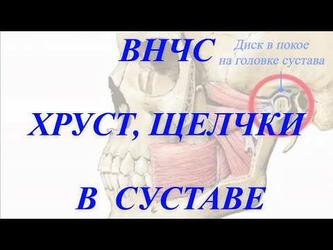 Видео: Хрустит и щёлкает нижняя челюсть. #Остеоартроз , передний вправляемый вывих диска.
