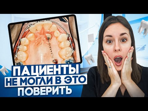 Видео: Кривые Зубы: 3 сложных случая при лечении на брекетах и элайнерах! Результаты ДО и ПОСЛЕ
