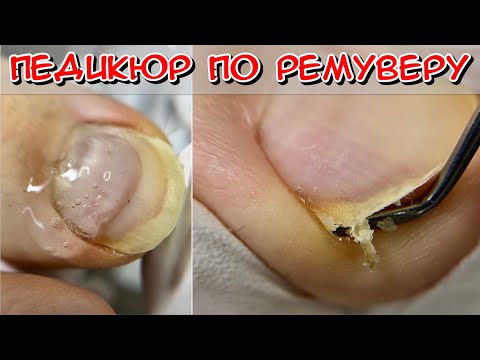 Видео: Педикюр по ремуверу / Как стричь ногти / мужской педикюр
