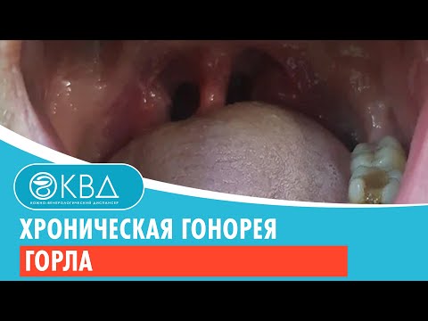 Видео: 😕 Хроническая гонорея горла. Клинический случай №811