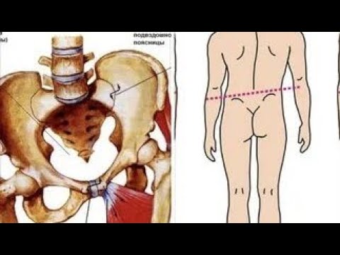 Видео: Выравнивание таза.