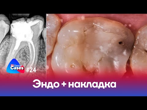 Видео: Эндо + накладка  | Дентал Кейсы от BG #24