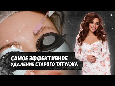 Видео: Новый способ удаление старого татуажа – 2 ЭТАПА: ЛАЗЕР + РЕМУВЕР