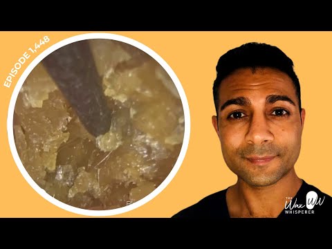 Видео: 1448 — Извлечение ушей, заложенных отмершей кожей, заполненной кератином