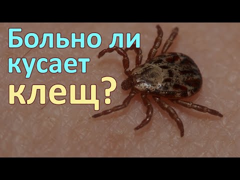 Видео: Больно ли кусает клещ и можно ли почувствовать его укус, чтобы сразу его снять?