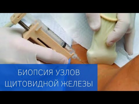 Видео: Пункционная биопсия узлов щитовидной железы в ЕМС