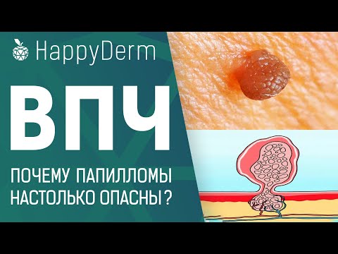 Видео: ВПЧ! ПРИЧИНЫ И ЛЕЧЕНИЕ. НАСКОЛЬКО ОПАСЕН ВИРУС ПАПИЛЛОМЫ ЧЕЛОВЕКА И КАК УДАЛИТЬ ПАПИЛЛОМЫ В МИНСКЕ