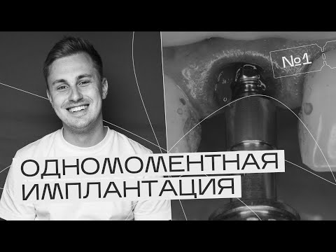 Видео: Одномоментная установка имплантата во фронтальном отделе. Фишки. Нюансы работы. Игорь Налиткин