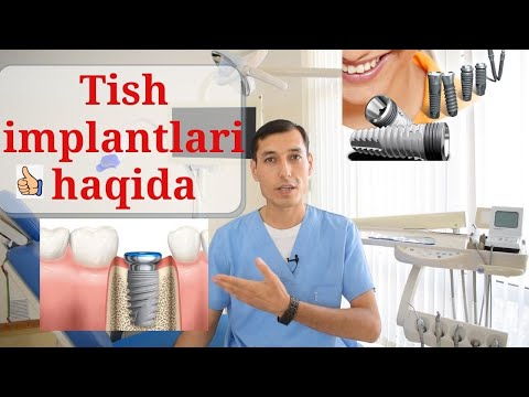 Видео: Имплант тишлар минус ва плюс тамонлари. Implant tishlar ijobiy va salbiy taraflari.