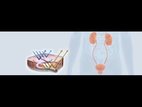 Видео: Защо при тумор на пикочния мехур да се лекувате в Хил клиник