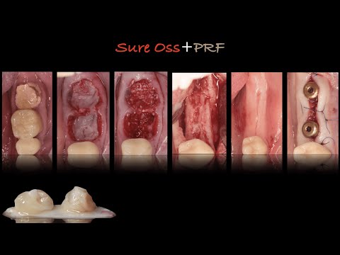 Видео: Удаление. Распил. "Мерседес". Plazma.