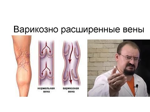 Видео: Варикозно расширенные вены на ногах