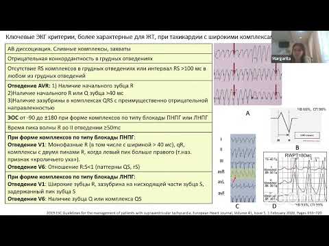 Видео: Дифференциальная диагностика аритмий: ключевые аспекты и алгоритмы анализа морфологии широких QRS