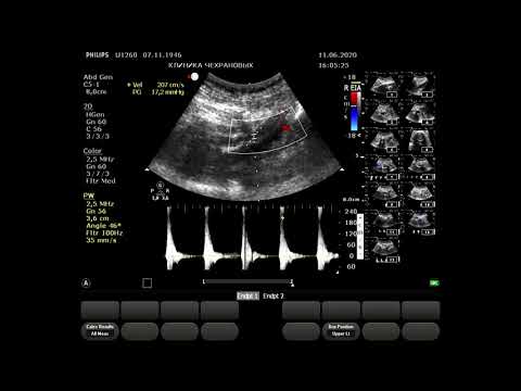 Видео: 2020061115545771 УЗИ артерий ног