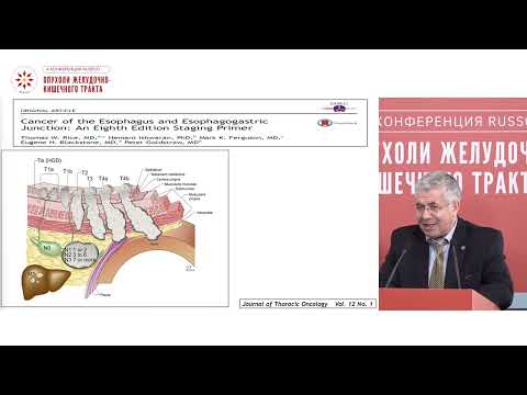 Видео: Оконтуривание при раке пищевода – мастер-класс для лучевых терапевтов