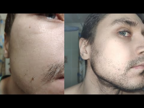 Видео: Как ОТРАСТИТЬ БОРОДУ/ЩЕТИНУ если она не растет. МИНОКСИДИЛ (minoxidil) и не только! Роман Воропаев