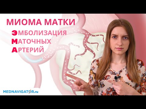 Видео: Удаление миомы матки методом ЭМА - эмболизация маточных артерий | Mednavigator.ru