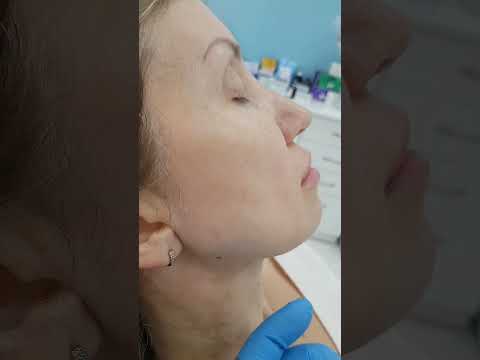Видео: Корректируем угол нижней челюсти филлерами. Формируем красивый профиль лица.