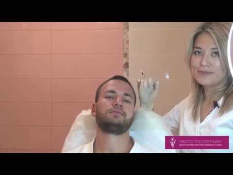 Видео: Коррекция морщин у мужчин