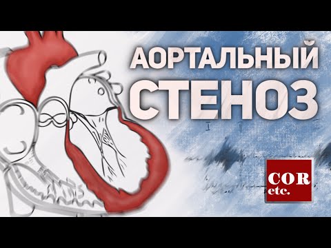 Видео: Аортальный стеноз.