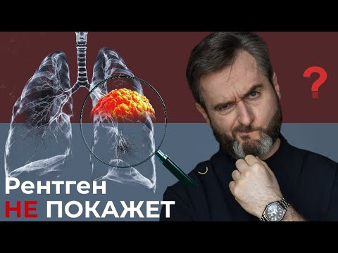 Видео: Пневмония, рак, туберкулёз. Когда рентген БЕСПОЛЕЗЕН?